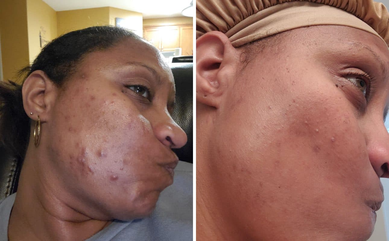 Before and after photos shared by Florence B.