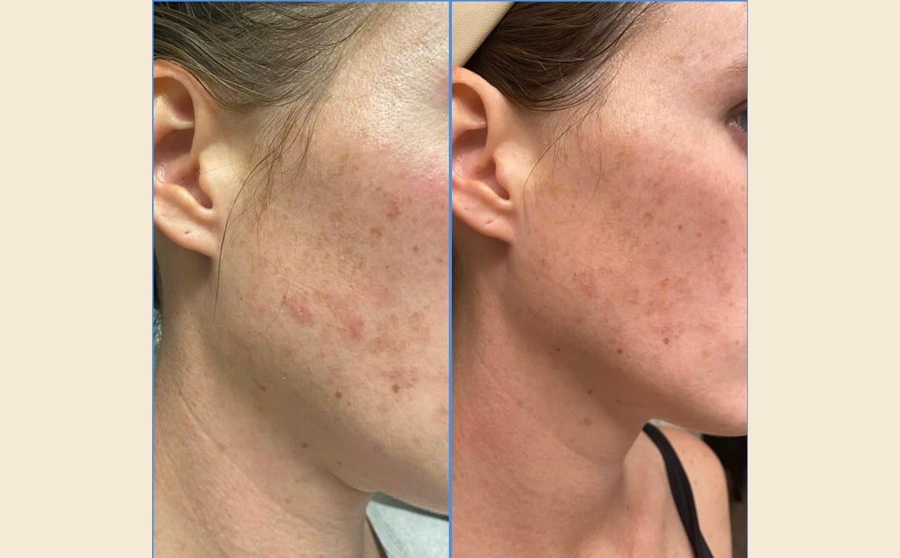 Before-and-after collage shared by Monica K.