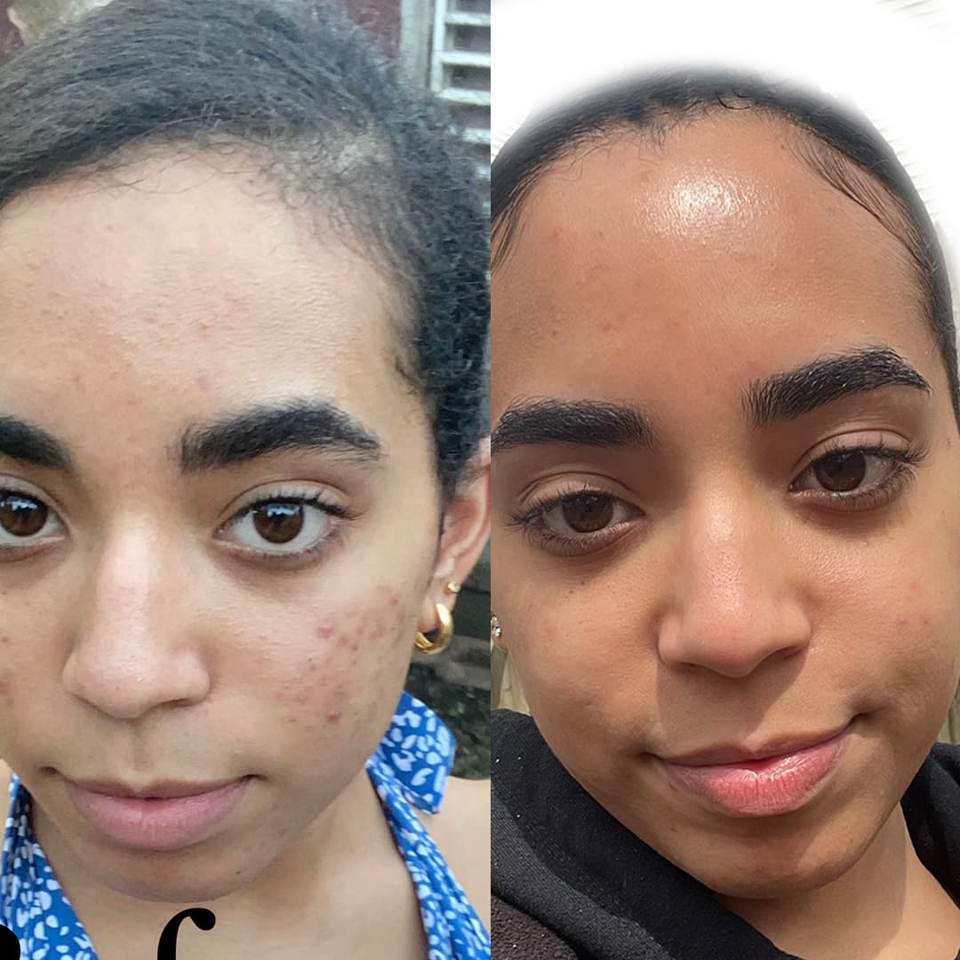 before and after image from using Gleaming Clay Mask for Roselyn T