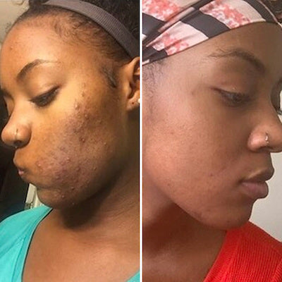 before and after image from using Gleaming Clay Mask for Nia L