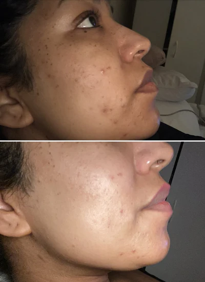 before and after image from using Gleaming Clay Mask for Rocio H
