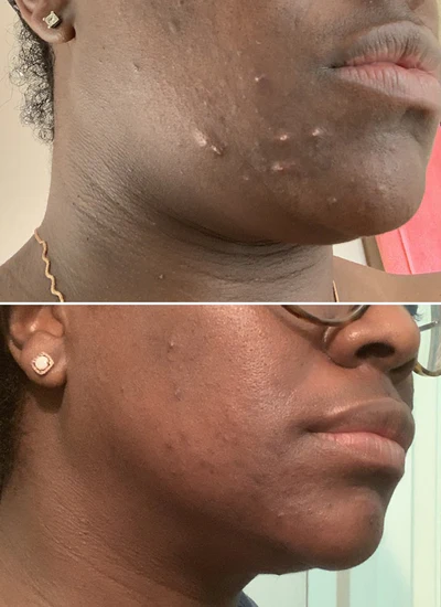 before and after image from using Gleaming Clay Mask for for Alishia T