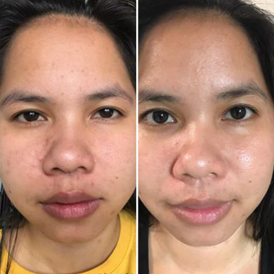 before and after image from using Gleaming Clay Mask for Kristin M
