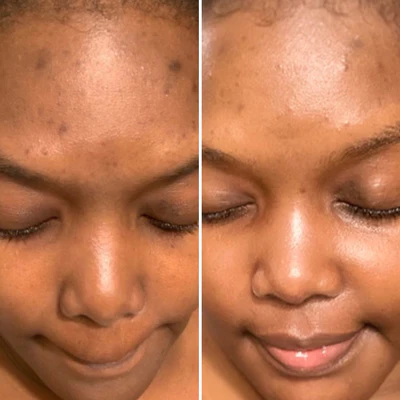 before and after image from using Gleaming Clay Mask for Lia L